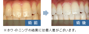 ホワイトニング術前・術後