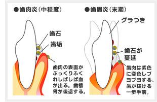 歯周病