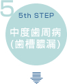 中度歯周病(歯槽膿漏)