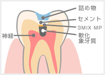 3Mix MP法